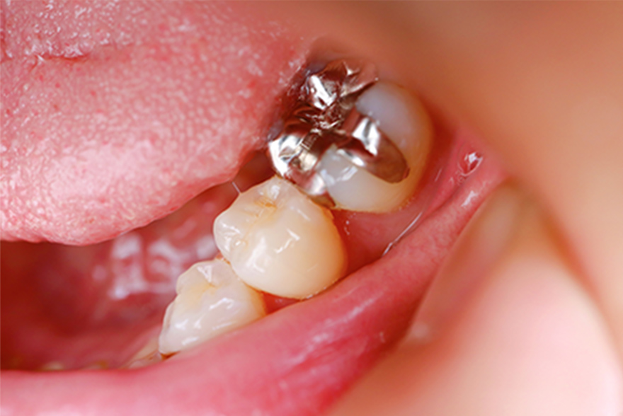 銀歯の問題点